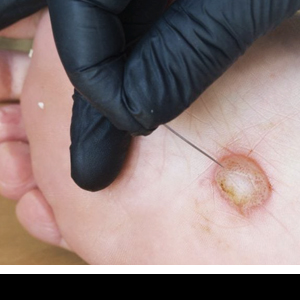 Diabetic foot ulcer on the sole of the foot.