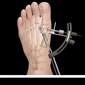 Bunion deformity being treated with minimally invasive surgery.